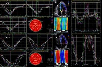 Abnormal left ventricular systolic reserve function detected by treadmill exercise stress echocardiography in asymptomatic type 2 diabetes